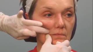 Lifting Mouth Corners amp Filling Marionette Lines With Dermal Filler [upl. by Adnahcal]