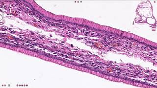 Ovary Mucinous cystadenocarcinoma [upl. by Tannen385]