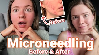 All About Microneedling Vlog  Before After and Everything in Between Healing PostAcne Skin [upl. by Smart279]