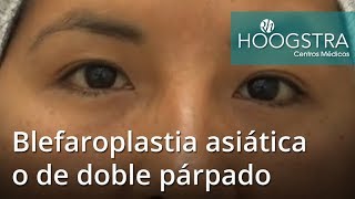 Blefaroplastia asiática o de doble párpado 19009 [upl. by Lauter]