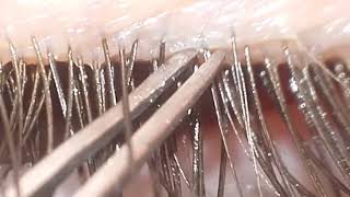 Eyelash Mites Demodex [upl. by Nasho379]