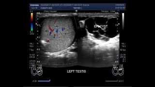 Epididymal Cyst Hydrocele and Varicocele cured in 25 days  Dr Health [upl. by Bunker]