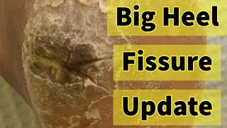 Big Heel Fissure Update The Heel Has Finally Healed [upl. by Yhpos]