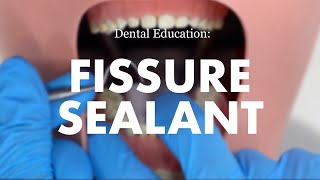 Placement of a Fissure Sealant [upl. by Auqenahs214]