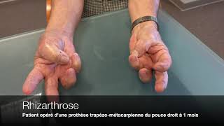 Main  Rhizarthrose ou Arthrose du pouce [upl. by Laon270]