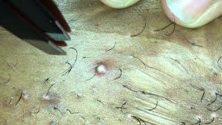 INFECTED INGROWN HAIR 05 [upl. by Leanard]