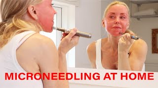 Microneedling DIY at Home  Tips Warnings and Demo  Over 50 [upl. by Zevahc973]