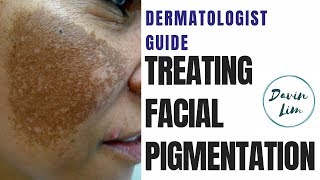 How to treat PIGMENTATION [upl. by Enyalaj]