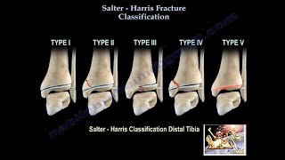 Salter Harris Fracture Classification  Everything You Need To Know  Dr Nabil Ebraheim [upl. by Arikal135]