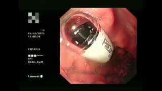 Capsule Endoscopy a helping hand [upl. by Boonie]