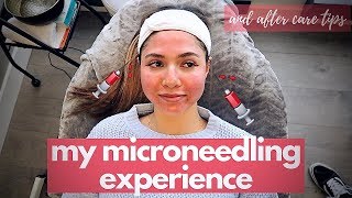 MICRONEEDLING PROCEDURE  aftercare tips skin updates before and after [upl. by Nylhtak286]