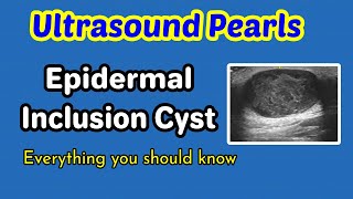 Epididymal cysts excision patient information [upl. by Eiramlirpa130]