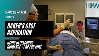 Bakers Cyst Aspiration  PRP [upl. by Wakeen975]