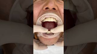 Korea 전체임플란트 세팅과정 Korean dentist Seoul Gangnam [upl. by Lerrud]