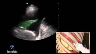 Ultrasound Tutorial DVT  Lower Limb Veins  Radiology Nation [upl. by Tormoria]