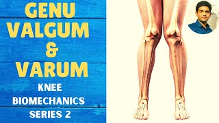 GENU VALGUM amp GENU VARUM  Knee Complex Biomechanics [upl. by Ocin]