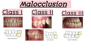 malocclusionsClass IClass IIClass IIIClinical featuresQuick Revision [upl. by Sanborne]