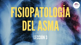 3 FISIOPATOLOGÍA DEL ASMA FISIOPATOLOGÍA RESPIRATORIA [upl. by Eiramesor]