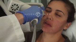 Syneron Profound Microneedling with Radiofrequency  Skin Facial Tightening and Lifting [upl. by Ingham]