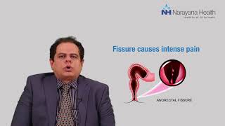 Piles Fissures amp Fistula Key Differences Explained by Dr Vikas Kapur [upl. by Tobin]